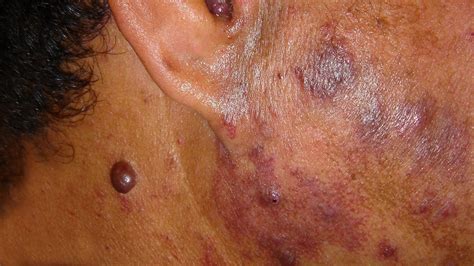 Port Wine Stain Diagnosis