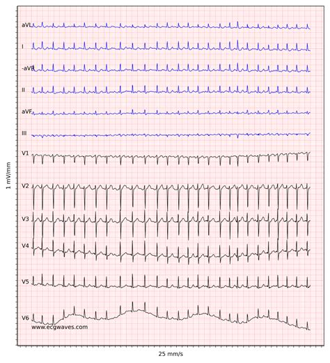 Atrial Fibrillation Ecg Classification Causes Risk Factors And Management Ecg And Echo