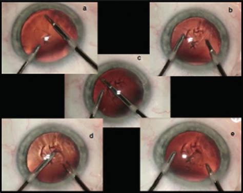 Phacoemulsification Cataract Surgery without Viscoelastic Substance ...