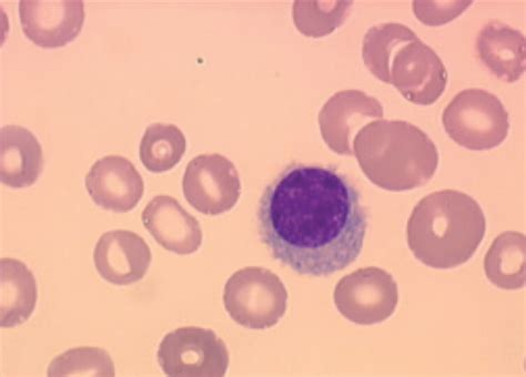 Jle H Matologie Treatment In Of Hairy Cell Leukemia And The