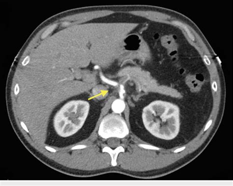 Computed Tomography Angiography Cta Of The Abdomen And Pelvis