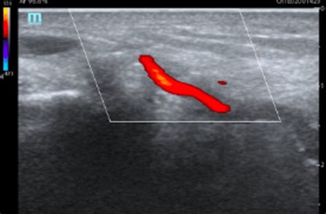 Doppler Ultrasound In Where It Seems A Temporal Artery Wall Thickened