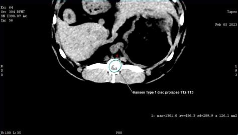 Hemilaminectomy following Hansen type 1 IVDD – Vetrainorg