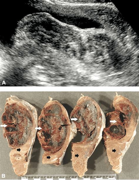 Placental Abruption A Grayscale Image Shows Thickened And