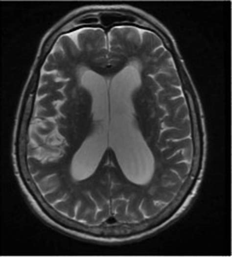 Intracranial Hypertension Beyond Csf Diagnosis And Treatment Msk