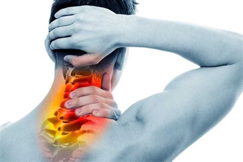 Mengenal Cervical Syndrome Yang Incar Tulang Belakang Anda Fisiohome