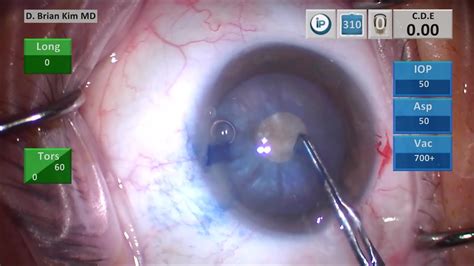 Intumescent Dense White Cataract Double Rhexis Technique To Prevent