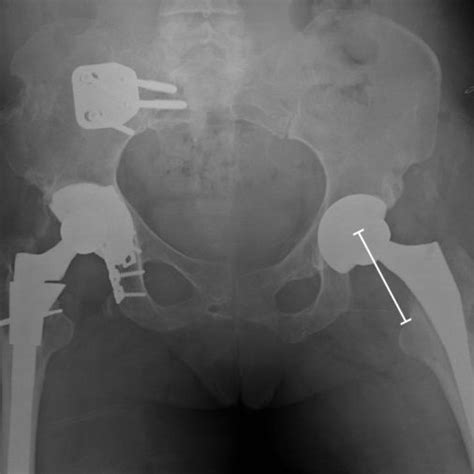 Anterior Hip Dislocation Following Revision Left Total Hip