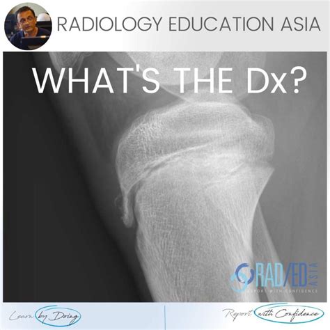 Tibial Tuberosity Xray