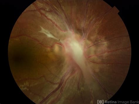 Toxocara Canis Retina