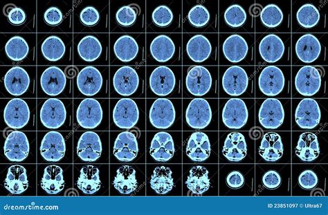 Brain CT Scan stock image. Image of ishemia, monitor - 23851097