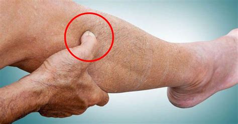 10 Warning Signs Of Clogged Arteries In Your Legs Peripheral Artery
