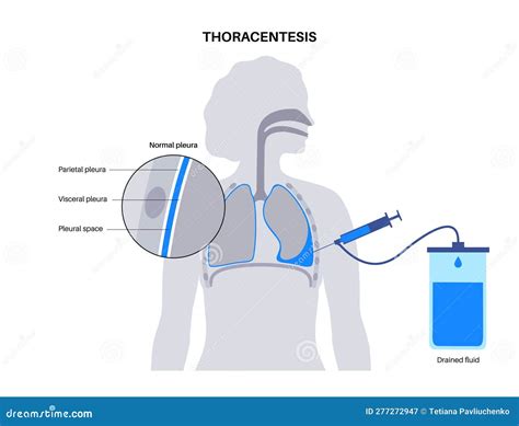 Thoracentesis Procedure Steps