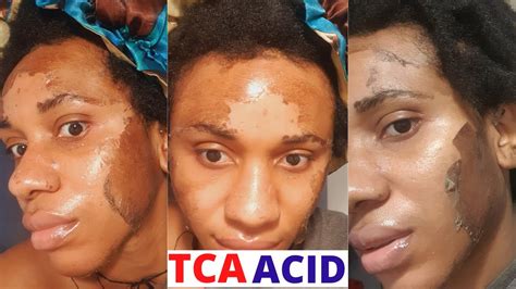 DIY 15 TCA PEEL AT HOME Day By Day Progress On BLACK SKIN PART 2