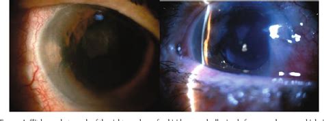 Figure From Argon Laser Synechiolysis For Irido Corneal Adhesion