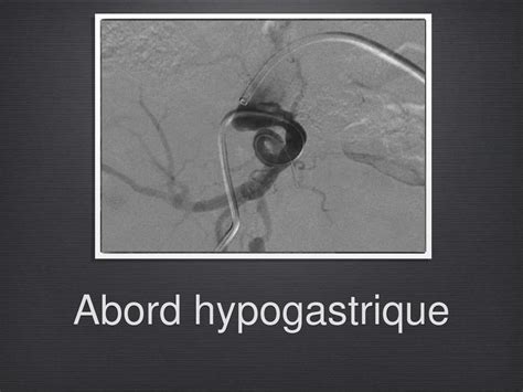 PPT Comment emboliser les artères hypogastriques PowerPoint