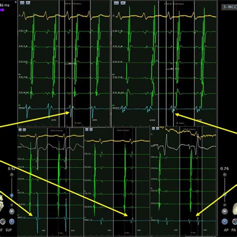 Mapping And Ablation Of Para Hisian Aps With Targets In Right Septal