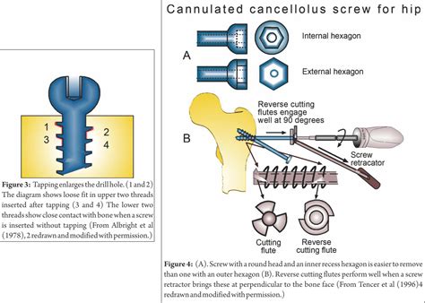 Biomechanics Of Cancellous Screw Trauma International