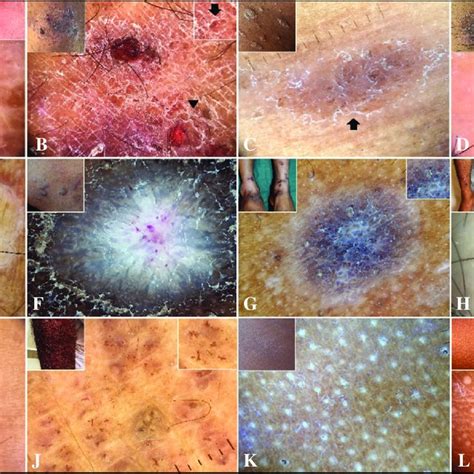 Dermoscopy Of Facial Hyperpigmented Dermatoses A H And Extra Facial