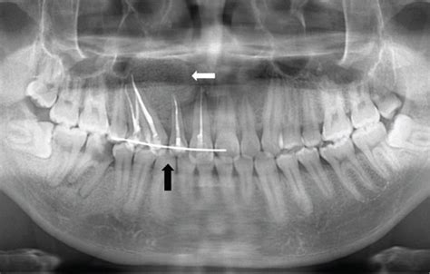 A Year Old Male Presenting With Odontogenic Keratocyst In The Right