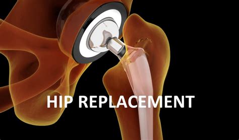 Physiotherapy After Hip Replacement Exercises Guide And Aftercare Ppc