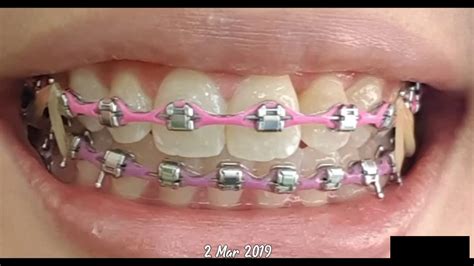 Trending Braces Time Lapse 2020 Damon Braces For Crooked Teeth Youtube