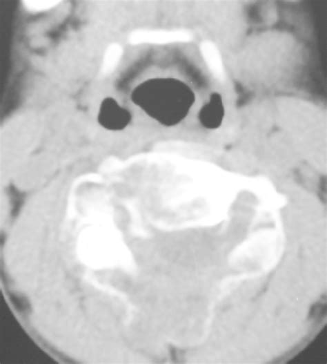 Computed Tomography Imaging Showing The Lytic Expansile Lesions Download Scientific Diagram