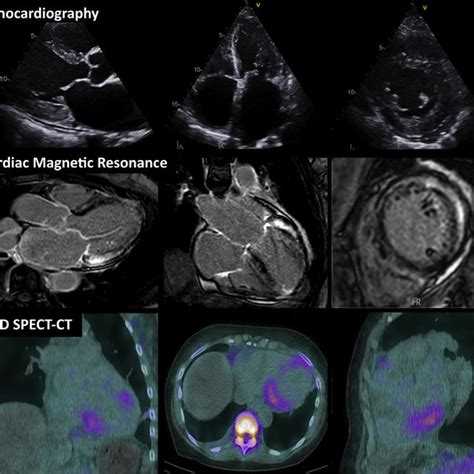 Typical Electrocardiogram Features Of Cardiac Amyloidosis Download