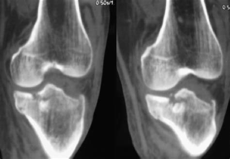 Pre Operative Ct Scan Of A Type V Tibial Plateau Fracture Download Scientific Diagram