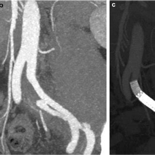 A And B Preoperative Computed Tomography Ct Angiography Showing