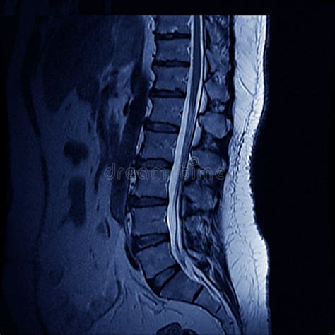 Mri Of Lumbar Spine Mr Stock Image Image Of Lumbar 13978373