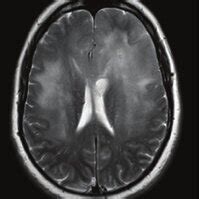 Subtype classification of gliomatosis cerebri (GC) cases.... | Download ...