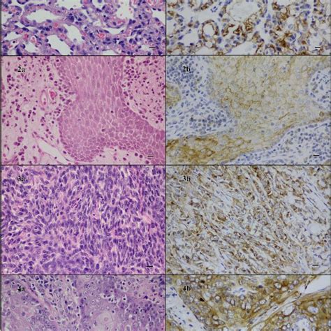chronic hyperplastic gingivitis expressed transferrin receptor