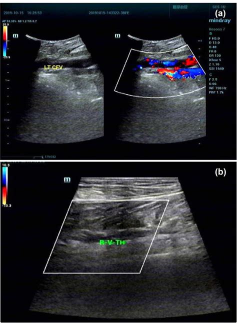 Doppler Ultrasound In Detection Dvt A Hypoechoic Filling Could Be Download Scientific