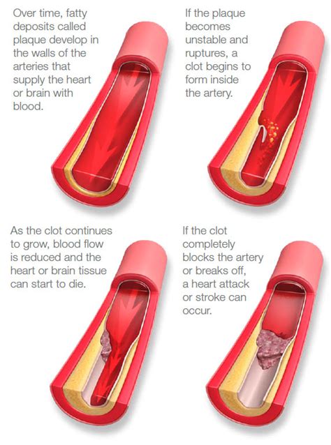 What are Heart Disease and Stroke? - Alpine Cardiology