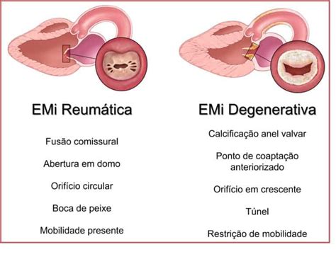 Estenose Mitral Degenerativa X Reum Tica Aspectos Ecocardiogr Ficos