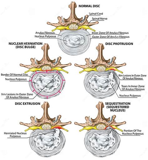 Board Nerves Stages Of Lumbar Disc Herniation Stock Illustration