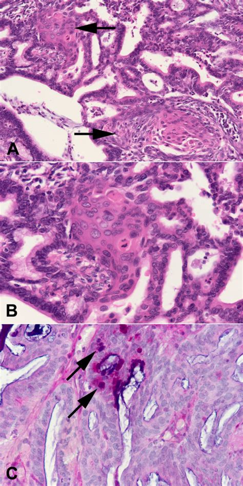 A And B Endometrioid Adenocarcinoma With A Cribriform Glandular