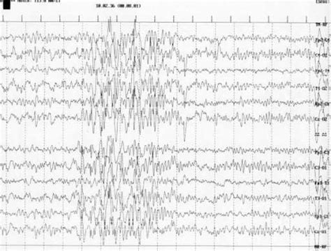 Epilepsi Patofisiologi Diagnosis Penatalaksanaan Alomedika