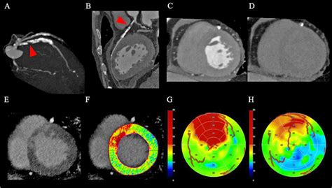 Figure 2 From Assessment Of Myocardial Viability In Chronic Myocardial