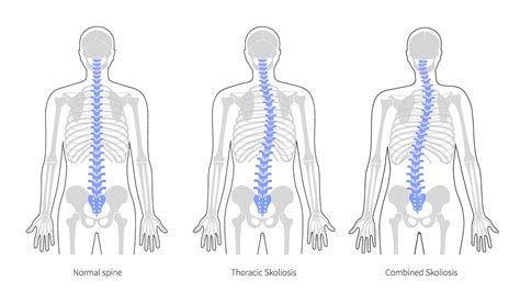 Scoliosis Operation Success Rate Evaluating Recent Data And Trends In