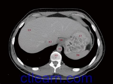 Learn Ct Scan Anatomy Ct Axial Abdomen And Pelvis Male