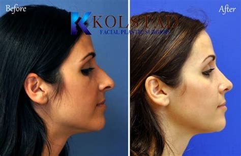 Hispanic Rhinoplasty Specialist Mexican Nose Job