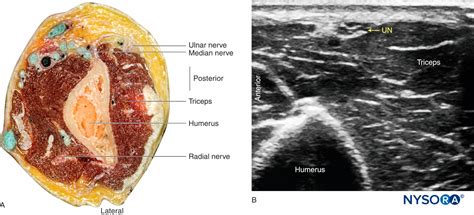 Regional Anesthesia The Ulnar Nerve NYSORA NYSORA