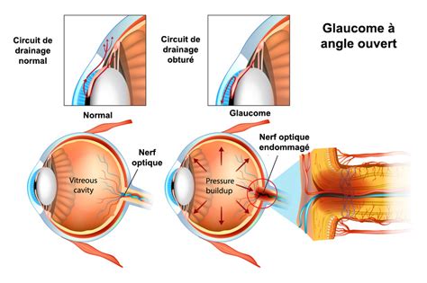 Glaucome Aigu Par Fermeture De L Angle Traitement