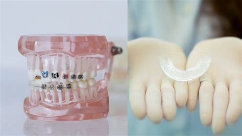 Metal Braces Vs Invisalign What S The Best Orthodontic Solution