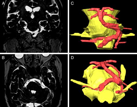 Coronal A And Axial B DRIVE MRI Sequences Showing Compression Of