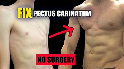 Improve Pectus Carinatum Pigeon Chest With Exercise YouTube