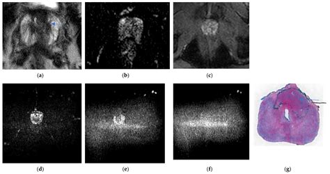 Life Free Full Text Prostate Mri Is Endorectal Coil Necessary—a Review