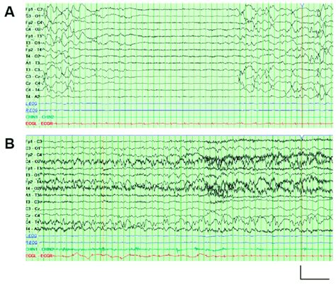 Eeg Recordings Performed On The Proband A An Interictal Eeg